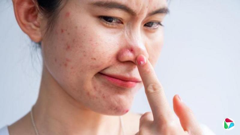 一位脸颊与鼻子上长有痤疮的年轻女子触摸着自己的鼻子,神情悲伤又带着烦躁